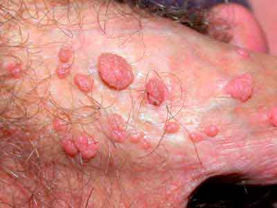 Photos of skin tags and genital warts